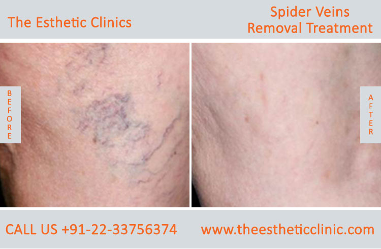 Spider Veins Removal Varicose Veins Laser Treatment before after photos mumbai india (1 (6)